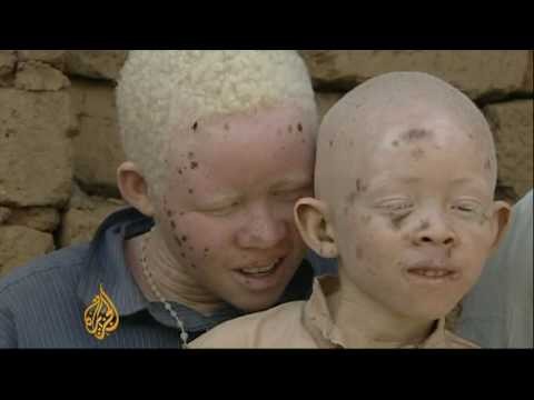 African albinos killed for body organs - 23 Jul 09