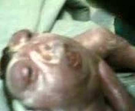 Anencephalic baby