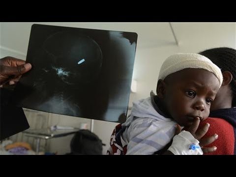 Photos of the Day - Bullet Lodged in Child's Head - March 26