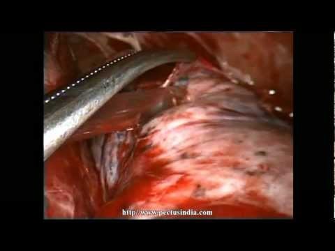 Thoracoscopy VATS Decortication in stage 2 empyema