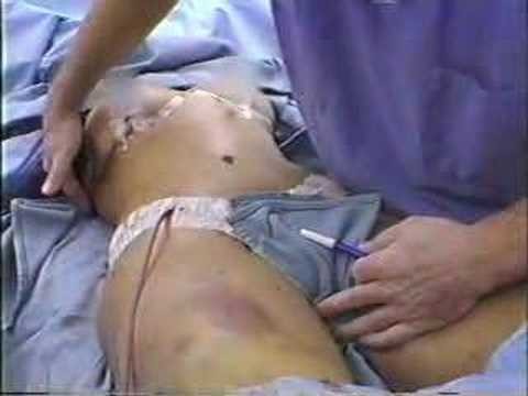 Total Body Lift Surgery Results -- Pittsburgh, Pennsylvania