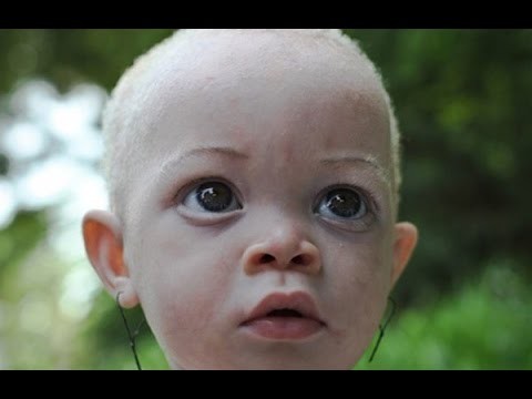Albinos Murdered In Tanzania Due To Superstition